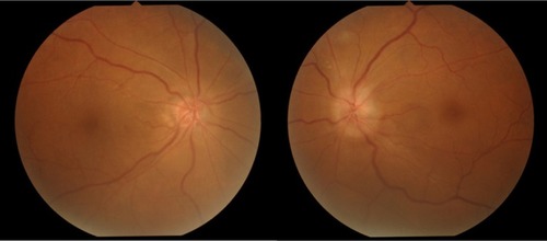 Figure 1 Color fundus photograph taken at onset.