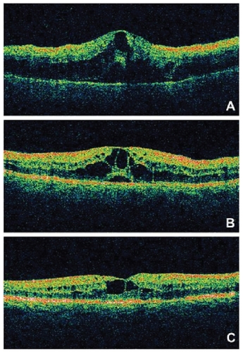 Figure 2 OCT recordings of the right eye of a 60-year-old male patient at presentation (A), 1 month after treatment (B) and 3 months after treatment (C). The pretreatment OCT showed an increase of central retinal thickness. Three months after treatment the OCT depicted the decrease of the retinal thickness of the fovea.