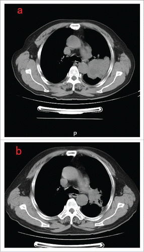 Figure 1. (a) Thoracic computed tomography before crizotinib treatment (b) 2 months after crizotinib treatment.