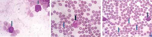 Figure 1. Photomicrograph of peripheral blood smear of representative leukemic rats showing the presence of blast (black arrow) and poikilocytosis (blue arrow).