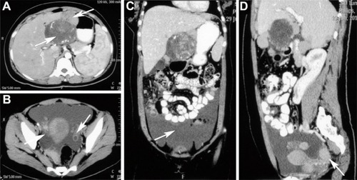 Figure 2 Computed tomography images of case 2.