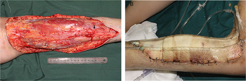 Figure 3 Surgery on the first day after admission. (A) The clearly necrotic tissue was entirely removed. Arrows indicate the sural nerve. (B) Two vacuum sealing drainage devices were installed after the debridement.