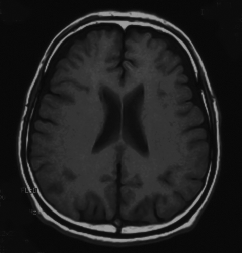Figure 1.  T1-weighted magnetic resonance image. Mild diffuse age-inappropriate brain atrophy is seen in the frontal lobe.