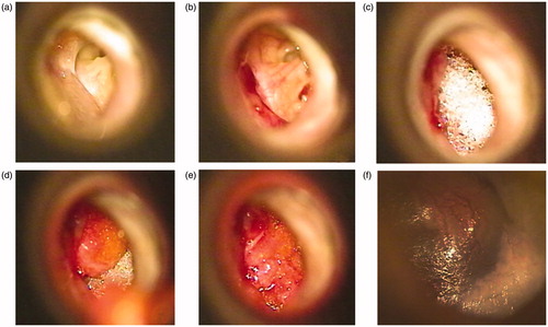 Figure 2. (a) Grade III perforation just before start of surgery showing a not inflamed middle ear. (b) The epithelial layer is lifted up. (c) Several pieces of MeroGel® are placed in the middle ear cavity. (d) On top of the MeroGel®, the harvested fat graft is placed. (e) Hyaluronic acid film is placed on the fat graft. (f) 6 weeks after surgery: the tympanic membrane is closed.