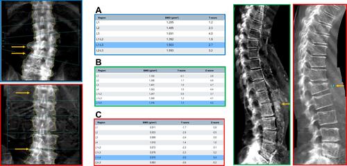 Figure 1 Examples of dual energy X-ray absorptiometry scans illustrating the limitations of the measurement at the lumbar spine. These examples illustrate frequent limitations encountered in the assessment of dual energy X-ray absorptiometry scans in older patients. Yellow arrows point out osteophytes and bone calcification in the blue squared lumbar spine picture. (A) Blue frame: The blue table related to the blue frame picture underline the impact in overestimation of BMD with osteoarthritis at lumbar spine. (B) Green frame: These figure point out the important aortic calcification in vertebral assessment picture, leading to conclude to normal BMD shown in the green frame table. (C) Red squared pictures emphasize the presence of an unseen vertebral fracture at the first lumbar vertebra (Genant II-stage). In the associated dual energy X-ray absorptiometry scan, this fracture was not suspected, so BMD was overestimated in L1 compared to L2.