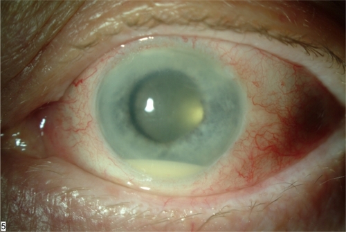 Figure 1 Slit lamp photograph, left eye, demonstrated layered hypopyon and fibrin formation in the anterior chamber.