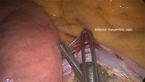 Figure 2. Dissection and clipping of inferior mesenteric vein.