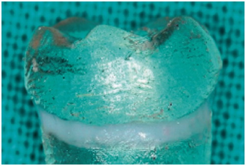 Figure 3. Duplicated tooth with demarcated CEJ.
