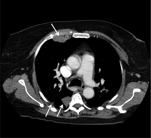 Figure 2. CT chest demonstrating bilateral peripheral and subpleural nodules consistent with malignant mesothelioma.