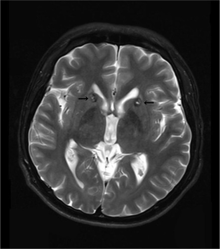 Figure 1 Lesions in the anterior limb of the internal capsule 3 months after surgery.