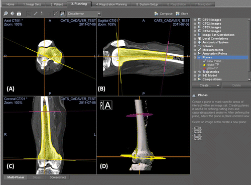 Figure 3. Preoperative screen images of surgical navigation planning on the navigation monitor for the cadaver study. The original CT image datasets (CT01) were fused with a modified CT dataset (CT02) containing the virtual CAD model of the test prosthesis, and with another modified CT dataset (CT03) containing the proximal and distal resection planes. The virtual CAD prosthesis and resection planes could be extracted with the aid of the segmentation tools in the navigation software. Proximal and distal resection planes were then marked as planned in the CAD software. Axial (A), sagittal (B) and coronal (C) images and the reconstructed 3D planning bone model (D) illustrate the transfer of the CAD virtual planning to the navigation system by the method of CAD to DICOM conversion and image fusion.