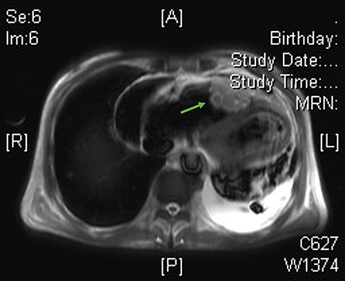 Figure 4 Cardiac magnetic resonance imaging on August 19, 2020, revealing a lobulated and infiltrative enhancing soft tissue mass, mainly located in the anterior wall of the right ventricle.