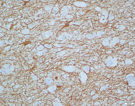 Figure 7 Immunohistochemistry staining for GFAP+ (diffuse astrocytoma).