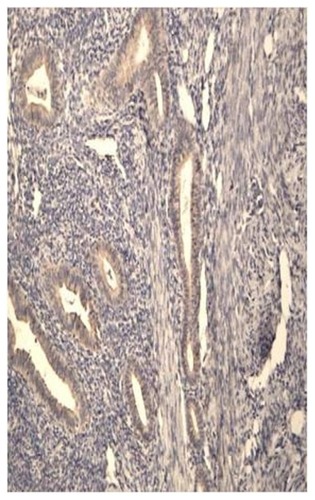 Figure 4 Aromatase expression in the glandular epithelium of a patient with adenomyosis during the proliferative phase.