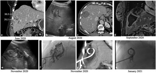 Figure 6. 70 yo with liver metastasis of pancreas adenocarcinoma, treated with MWA. (a) portal phase CT scan, coronal plane; (b) intraprocedural ecographic image of the lesion (c) portal phase coronal and axial CT scan showing necrosis in the ablated zone, without evidence of residual disease; small air bubbles (arrow) are present, a common finding after the procedure, which normally disappear during follow-up. (d) portal phase MR performed one month after the ablation revealing an asymptomatic biloma; (e) US examination of the abdomen was performed 3 months after the ablation due to fever, revealing an infected biloma, treated with a percutaneous drainage tube (f, g, h).