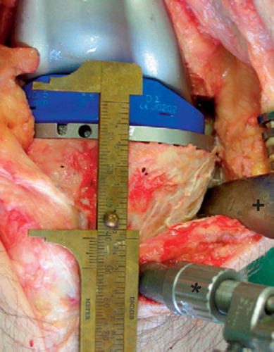 Figure 3. Subperiosteal release of the anteriomedial tibial sleeve 4 cm below the joint line with trail components in situ and tibial navigation reference array (*) in situ, and surgical hook (+).