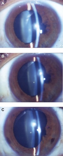 Figure 2 Change of nuclear sclerosis (NS) in a typical case of the diabetic retinopathy group.