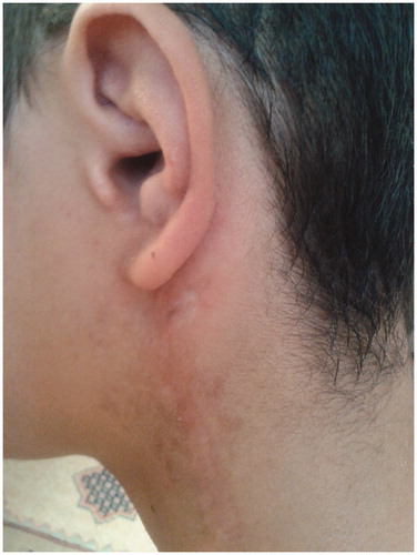 Figure 6. The auricle and external auditory canal photographed 2 years postoperatively.