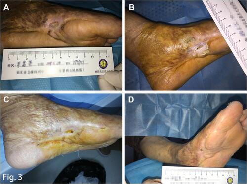 Figure 3 Ulcer healing and follow-up. (A) Wound status after the second autologous platelet-rich gel treatment; (B) Complete wound closure was observed after a treatment period of nearly 5 months; (C) Foot condition at the 1 month follow-up; (D) After the intervention, and 1 year after she left the hospital, the patient was without ulcer recurrence.