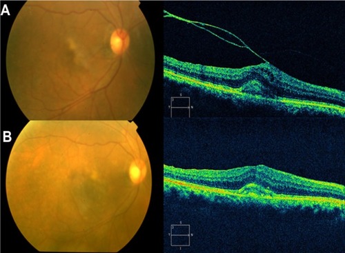 Figure 24 Pre- and postoperative OCT images.