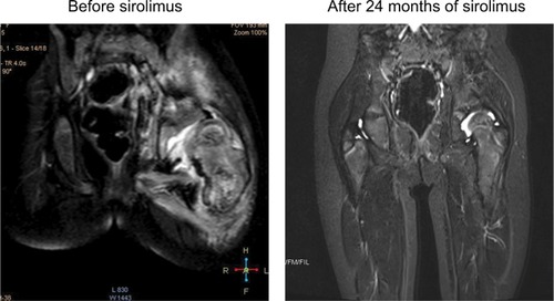 Figure 2 MRI changes in KHE with decreased hip ROM before and at 24 months after treatment.Notes: A 2.2-year-old girl demonstrated progressively decreased hip ROM for 12 months (left). Coronal T2-weighted MRI revealed a deep lesion infiltrating the proximal femur and ilium. MRI at 24.0 months after sirolimus treatment revealed nearly complete involution of the lesion (right).Abbreviations: KHE, kaposiform hemangioendothelioma; MRI, magnetic resonance imaging; ROM, range of motion.