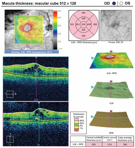 Figure 1 Optical coherence tomograph of a patient in group 1 at the preoperative visit.