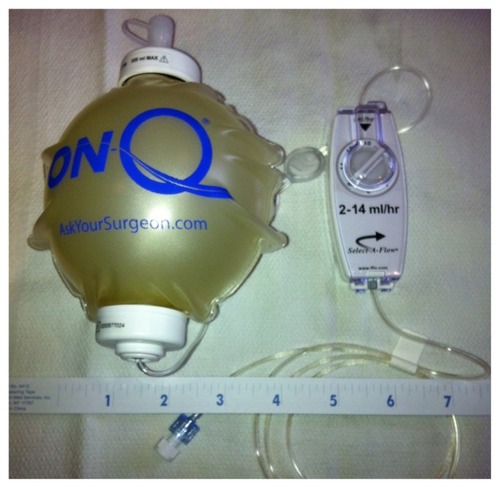 Figure 1 ON-Q Pain Buster® Post-op Pain Relief System (I-Flow Corporation, Lake Forest, CA).