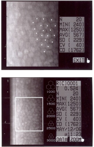 Figure 10 Specular microscopy in OD.