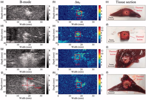 Figure 7. Representative results obtained using the ultrasonic B-mode, Δα0 and tissue section images of thermal lesions in the in vivo porcine liver immediately after MWA at (a–f) 40 W and (g–l) 70 W.