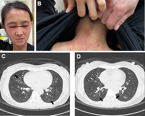 Figure 1 Skin photographs and chest images from an anti-MDA5-positive ADM patient with early-stage ILD before extended-release Tof treatment. Reddish-purple discoloration around the eyelids with swelling (heliotrope rash) (A) and erythematous area on the upper back and posterior neck (shawl sign) (B). Bilateral diffuse infiltration with ground-glass opacity (GGO) on high-resolution chest CT (C and D) at the diagnosis of ILD. Arrows indicate the GGO infiltration.