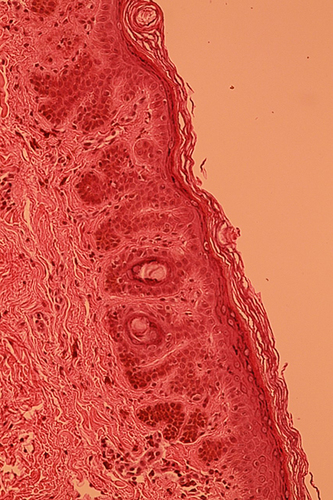Figure 4 Elongation of epidermal buds, hyperpigmentation of basal keratinocytes without associated melanocytic hyperplasia (HES x 20).