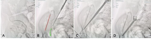 Figure 1. Ideal fluoroscopy during surgery is one of the keys to successful surgery. (A) The ilial oblique view was used to confirm that the direction of screw insertion crossed the greater sciatic notch and pointed to the anterior inferior iliac spine. (B) The modified obturator inlet view (20°–30° examination side tilt combined with 30° inlet tilt) was used to confirm that the direction of screw insertion did not penetrate the inner and outer plates of the ilium (red line, outer plate of the ilium; green line, inner plate of the ilium). (C) After the direction of screw insertion is determined correctly, a screw path of 80–100 mm in length was made by an awl. (D) After a ball-tip probe confirmed that the four walls were intact, an S2AI screw was inserted along the screw path.
