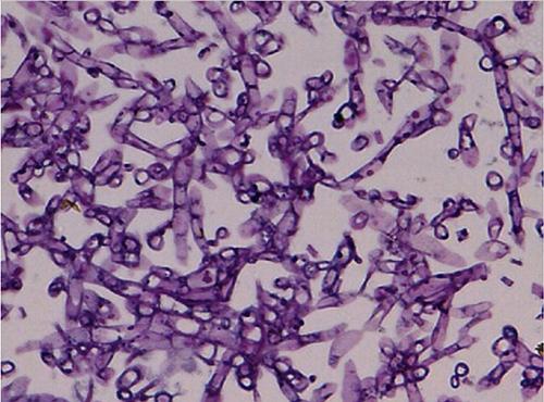Figure 4 Histopathology of the gastric biopsies had shown a typical of Muchorales image, suggestive mucormycosis.