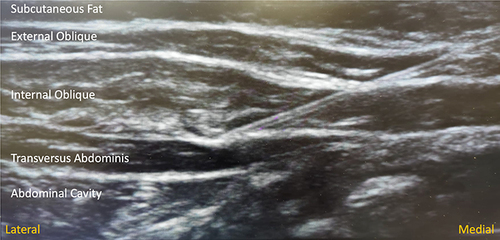 Figure 3 Ultrasound image of needle access of the fascia underlying the internal oblique and the fascial layers of the internal oblique and transverse abdominis muscles.