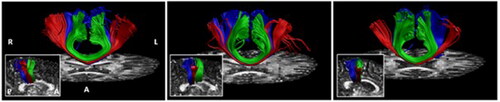 FIGURE 1. Copied with permission from Gooijers et al. (Citation2021). Tracked callosal motor fibers (red: hand M1, blue: Feet M1, green: SMA) are visualized on individual FA maps. The in-set shows callosal motor fibers in a midsagittal view.