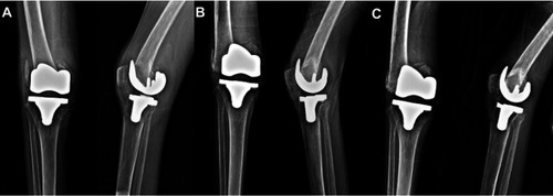 Figure 6 An 87-year-old woman was admitted to the hospital with a transfer fracture in the distal femur. (A) On simple radiography, a fracture with shortening to the upper part of the femur component in the total knee replacement state was observed. (B) A 10-week radiograph after the sponge cast was applied (C) A 16-week radiograph after sponge casting, which shows that union of the fracture was not prominent, but no pseudo-motion remained.