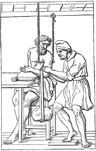 Figure 7. Reduction of a fractured humerus according to De Fracturis (c. 415 BC). Reprinted from É. Littré (Citation1841) 152.