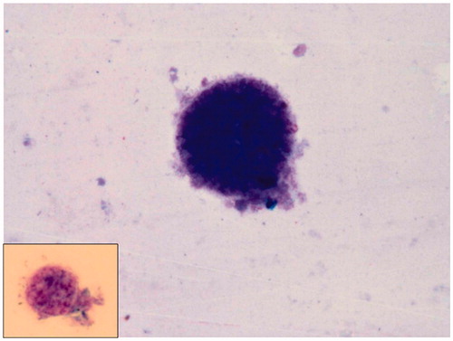 Figure 5. Vitreous smear (case 2) showing structures consistent with Toxoplasma gondii cysts in the main picture and in the inset (May-Grumwald Giemsa, ×1000).