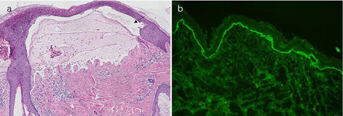 Figure 2 (a) A cleavage between the epidermis and dermis with a few infiltrations of eosinophils and lymphocytes. (b) Direct immunofluorescence showed IgG was deposited linearly in the basement membrane zone.