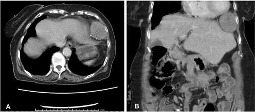 Figure 3 Axial (A) and coronal (B) CT scan of the abdomen/pelvis with IV contrast injection, demonstrated a new left cardiophrenic lymph node enlargement.