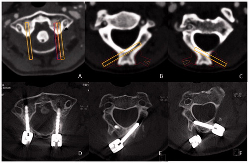 Figure 1. The 3D computer model of cervical vertebra and screw insert templates in case1 (A) and case 2 (B).