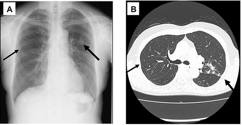 Figure 1 Chest X-ray (A) and computed tomography (CT) (B) findings of patient 1. Arrows indicate the abnormal small nodules, infiltrate shadows, and bronchiectasis.