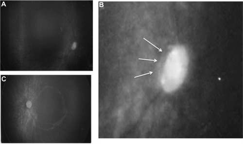 Figure 4 (A) Fundus image of the patient’s right eye. The DM/DD ratio was ~4.0. (B) Enlarged view of the right optic-nerve disc showing a tilted disc and a double-ring sign (arrows). (C) Left-eye fundus image. The DM/DD ratio was ~2.8.
