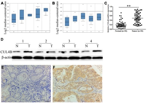 Figure 1 Clinical significance of CUL4B expression in GC patients. CUL4B mRNA expression based on Oncomine datasets: DErrico gastric (A) and Chen gastric (B) no value (0), diffuse gastric adenocarcinoma (1), gastric adenocarcinoma (2), gastric intestinal type adenocarcinoma (3) and gastric mixed adenocarcinoma (4). (C) Real-time PCR analysis of CUL4B mRNA expression in 50 human GC tissues and corresponding normal mucosa. **P<0.01. (D) Western blot analysis of CUL4B protein expression in 4 representative paired GC tissue samples. Immunohistochemical staining for CUL4B in adjacent normal mucosa (E) and GC tissues (F). Original magnification: 200×.