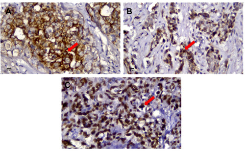 Figure 1 Immunohistochemistry of (A) CK5/6 (red arrow: positively stained in cytoplasmic membrane and cytoplasm of tumor cell). (B) EGFR (red arrow: positively stained in cytoplasmic membrane and cytoplasm of tumor cell). (C) p53 mutant (red arrow: positively stained in nucleus of tumor cell). Bar: 10 µm. Magnification: 400 times.