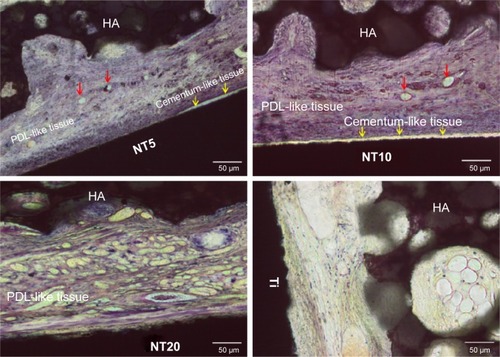 Figure 11 The Ti/cell sheets/HA interfaces analyzed by the hard tissue slicing and Van Gieson staining 8 weeks after the subcutaneous transplantation of the Ti/cell sheets/HA complexes in mice. The red arrows indicate the blood vessels, and the yellow arrows indicate the regenerated cementum-like tissue.Abbreviations: HA, hydroxyapatite; NT, nanotube; PDL, periodontal ligament; Ti, titanium.