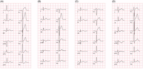 Figure 1. ECGs (25 mm/s) from four patients with different ST elevation etiologies. (A) Patient with STEMI. ECG shows PR depression ≥0.05 mV in the limb leads, but not in the chest leads, and slight ST elevation in aVR. (B–D) Non-ischemic patients with ST elevation (B: perimyocarditis; C: takotsubo cardiomyopathy; D: ERS). Both (B) and (C) show PR depression in both limb leads and chest leads, in (D) minor PR depression is present in the limb leads, and PR depression ≥0.05 mV in lateral chest leads. All non-ischemic patients show some degree of ST depression in aVR.