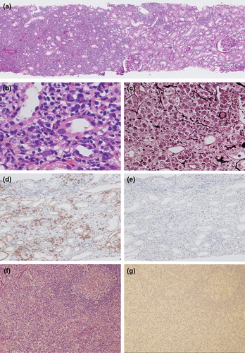 Figure 2. (a)–(e) Renal biopsy, (f)–(g) Inguinal lymph node biopsy. (a) Renal biopsy reveals lymphoplasmacytic infiltration with fibrosis mimicking IgG4-related tubulointerstitial nephritis. A regional lesion distribution is evident. The glomeruli and vessels show only minor abnormalities (PAS, × 100). (b) Dense infiltration of plasma cells and lymphocytes is seen. A few eosinophils are also seen (HE, × 400). (c) Lymphocytes and plasma cells are surrounded by storiform fibrosis, the so-called bird's eye pattern (PAM, × 400). (d) Infiltration of many plasma cells is seen (CD138, × 100). (e) IgG4-positive plasma cells are infrequent (IgG4, × 100). (f) Decreasing lymph follicle, atrophic follicle, expansion of interfollicular region and dense plasma cell and lymphocyte infiltration with a few eosinophils (HE, × 100). (g) IgG4-positive plasma cells are infrequent (IgG4, × 100).