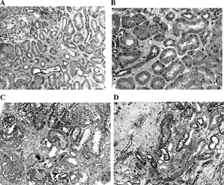 Figure 1. Varying extent of kidney cortex damage in two BEN patients. (A) Small scattered areas of discrete interstitial sclerosis with apparently normal tubuli. Segmental widening of the mesangium and discrete periglomerular sclerosis. Trichrom Masson × 100. (B) Discrete interstitial sclerosis and apparently normal proximal tubular epithelial cells on a larger magnification. A small arterial blood vessel with a thickened, partly hyalinized wall and narrowed lumen, similar to that in benign nephroangiosclerosis. Trichrom Masson × 200. (C) Larger areas of acellular interstitial sclerosis accompanied by tubular atrophy. Two glomeruli are seen: one in advanced sclerosis and the other with widening of the mesangium. Marked periglomerular sclerosis. Trichrom Masson × 100. (D) Juxtamedullary cortex with advanced acellular interstitial sclerosis and tubular atrophy. Trichrom Masson × 100.