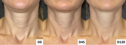 Figure 4 Neck rejuvenation with hyperdiluted calcium hydroxylapatite. At inclusion (D0 – before injections), before the second session (D45), and after 120 days of inclusion (D120). Woman, 42 years old, type II skin phototype. By D120, the Merz horizontal neckline grade had improved from 2 to 1, and the Merz neck laxity grade had decreased from 2 to 0.